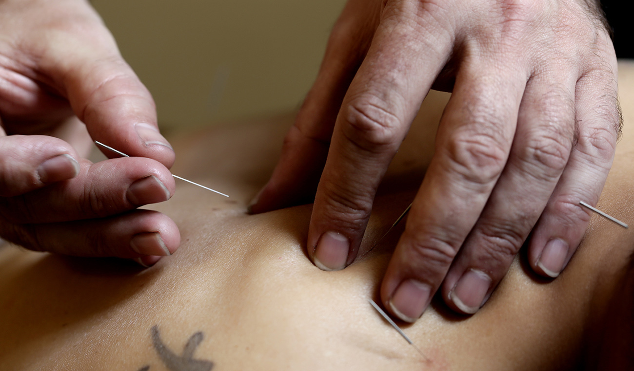 – Acupuncture –